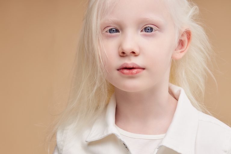 Albinismo: cause e tipi