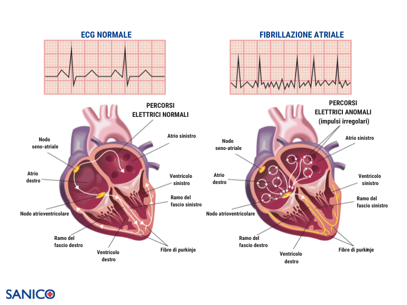 Fibrillazione-atriale-rappresentazione-grafica-atrio-e-ventricolo